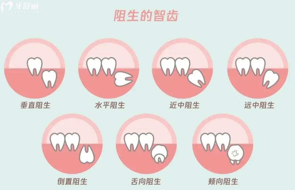 拔智齒