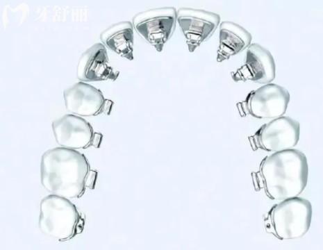 廣州牙齒矯正多少錢價格表2023