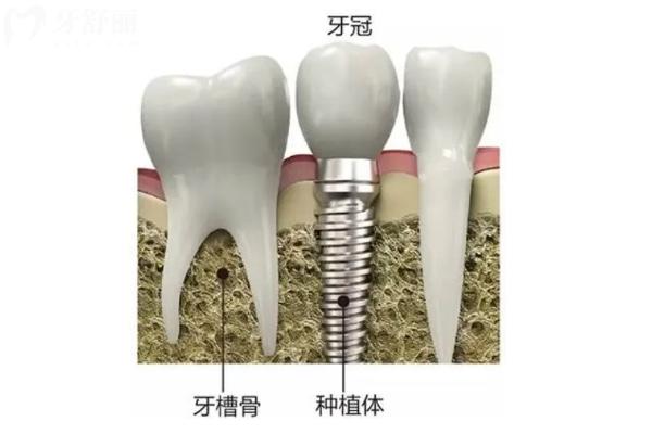 種植體示意圖.jpg