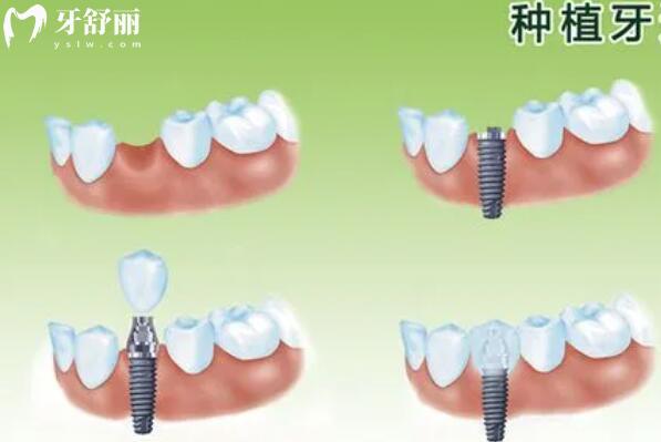 上海徐匯區(qū)滿口種植牙多少錢?集采后全口/半口/單顆費用