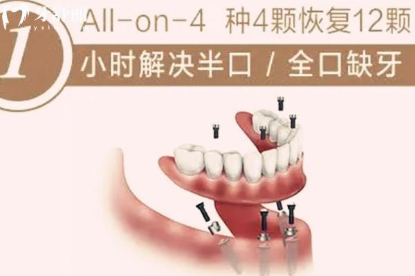 all-on-4種植