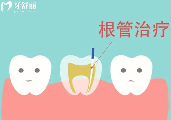 根管治療