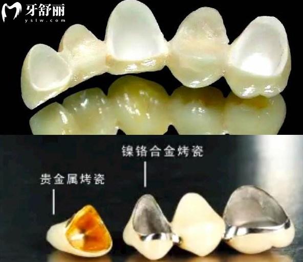 各種材質(zhì)的牙冠