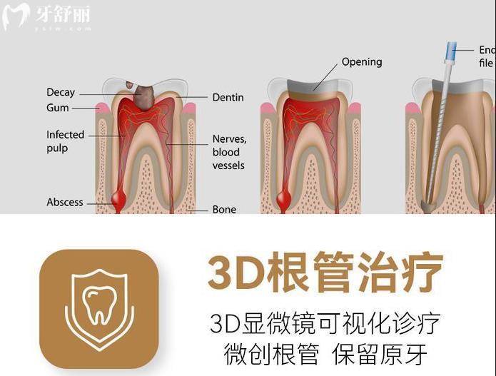 根管治療