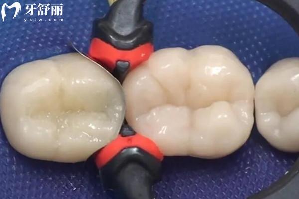 韶關補牙價格