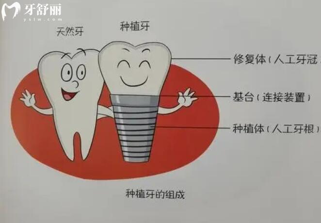種植牙價(jià)格