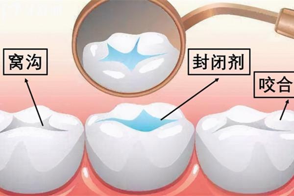 兒童窩溝封閉