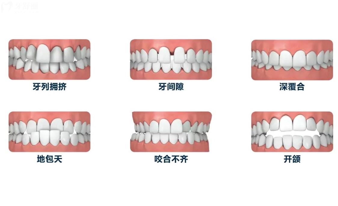 哪些牙齒需要做矯正