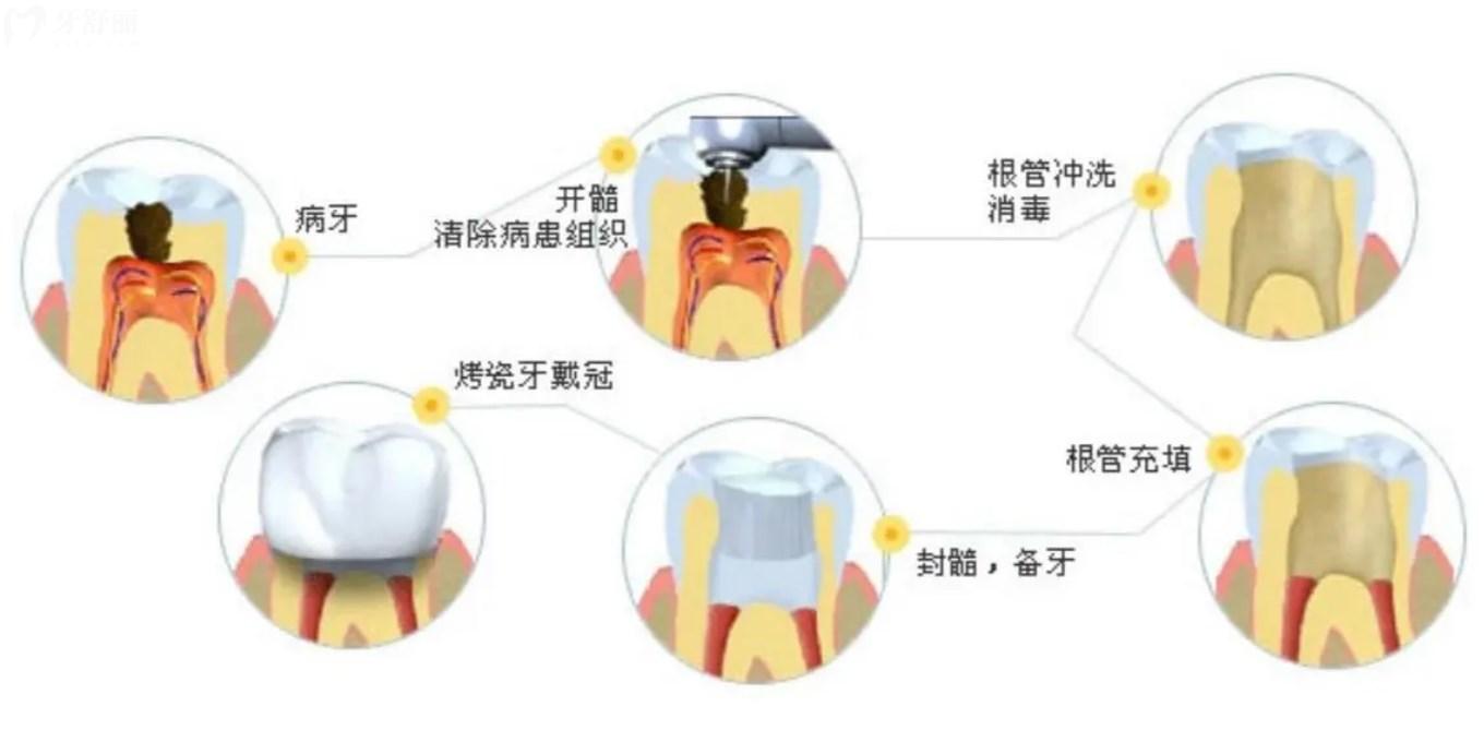 根管治療