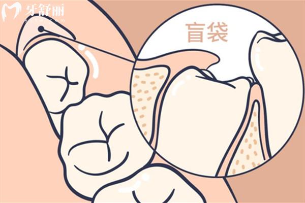 智齒盲袋