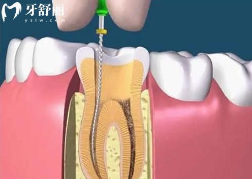 根管治療