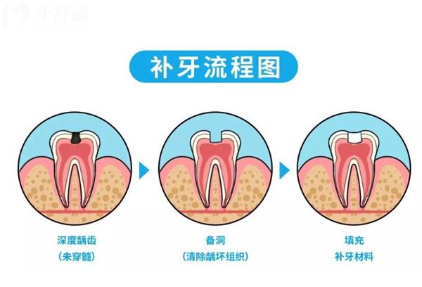 補牙流程圖