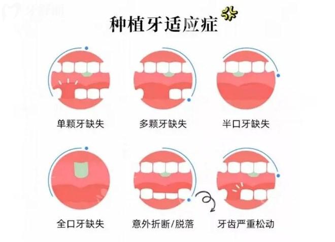 哪些人需要做種植牙