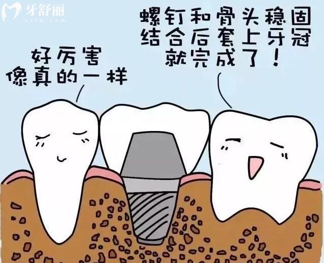 種植牙的優(yōu)勢