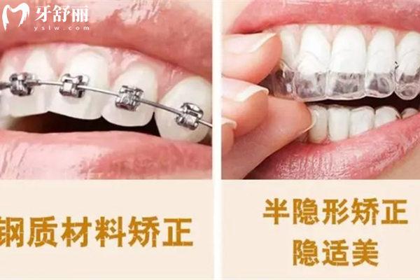 牙齒矯正