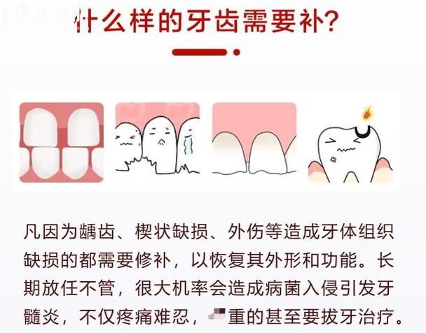 補(bǔ)牙
