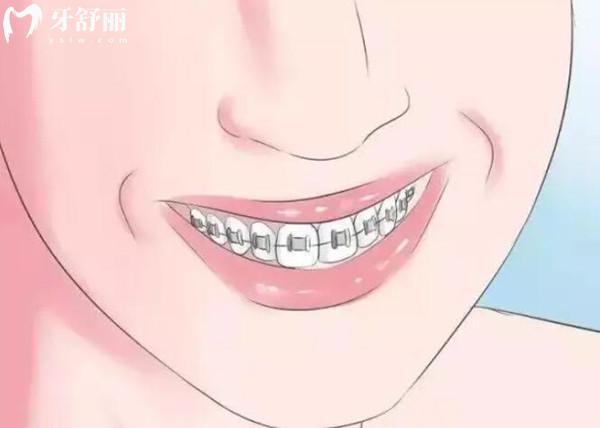 義烏牙齒矯正