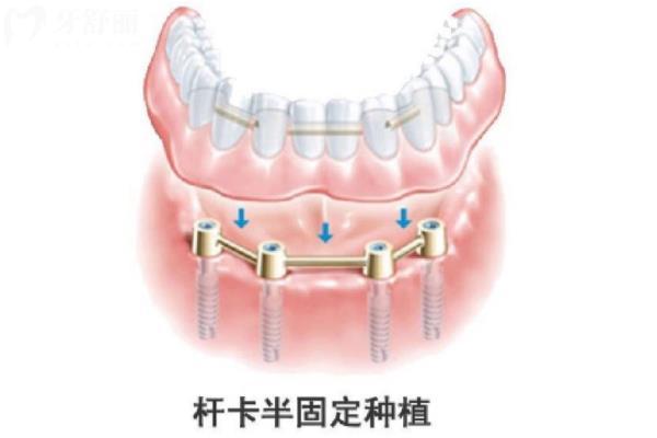 鑲牙