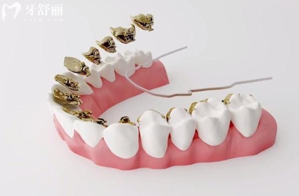 舌側(cè)矯正