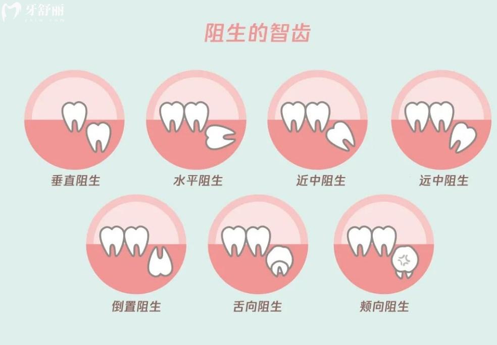 拔智齒類型