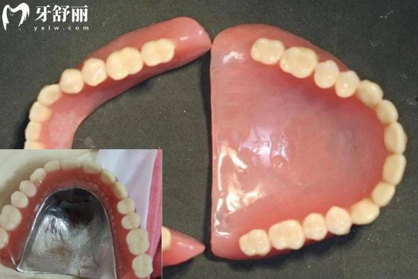 樹(shù)脂假牙
