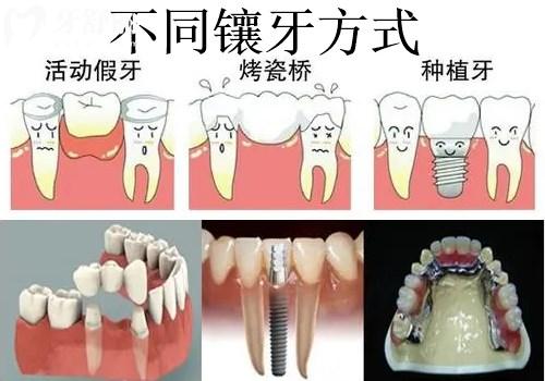 鑲牙方式對比