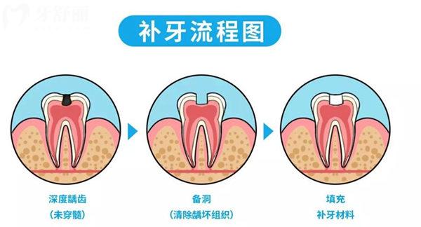 補(bǔ)牙流程