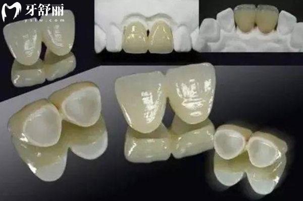 全瓷牙