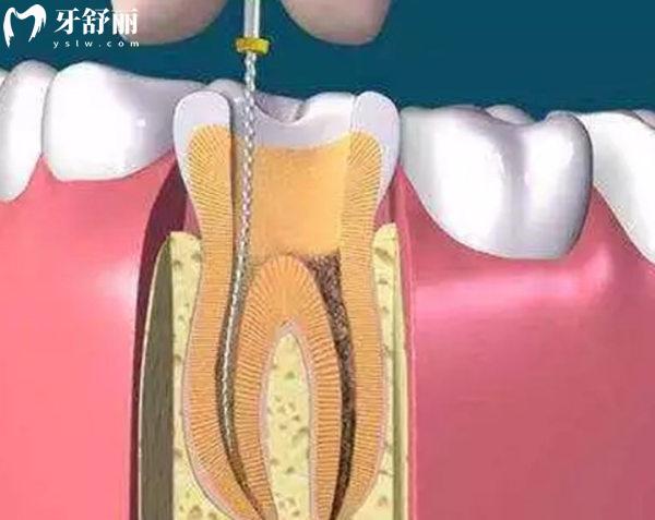 天津根管治療費(fèi)用