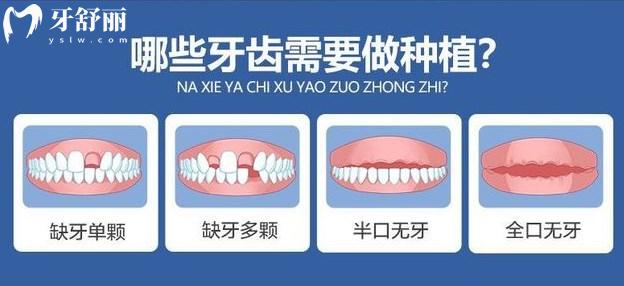 哪些人需要做種植牙