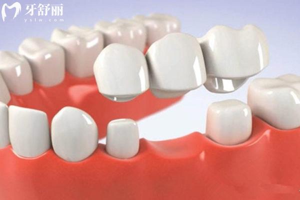 石家莊市**全瓷牙價格