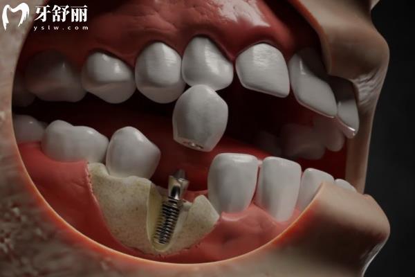 宜春牙科收費(fèi)價(jià)格標(biāo)準(zhǔn)--種植牙
