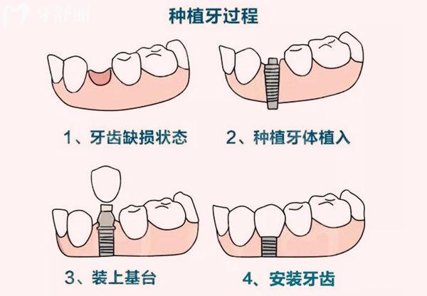 北京冠美口腔種植牙過(guò)程