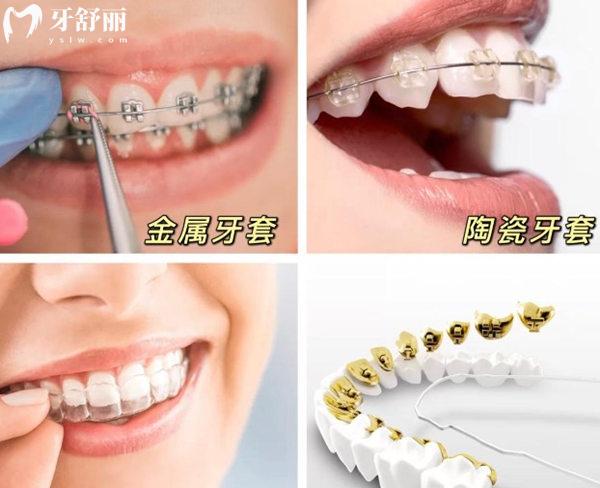 牙齒矯正圖