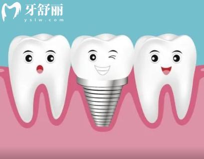 池州康諾口腔門診部種植牙價(jià)格表