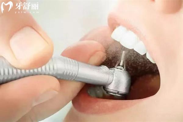 酒泉看牙收費價格表
