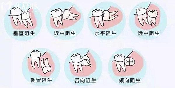 北京**口腔拔智齒