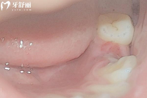 拔牙