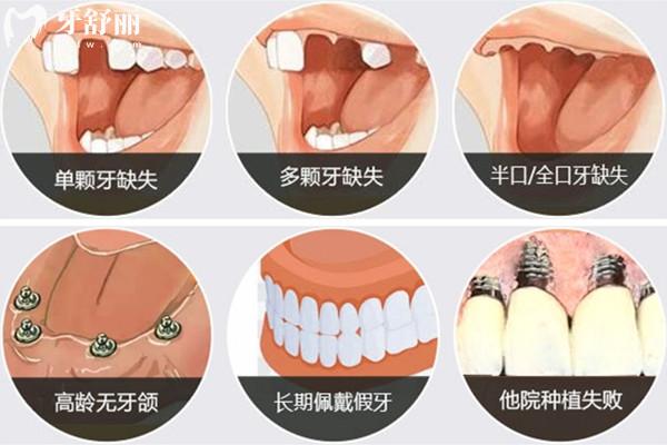 種植體適用人群