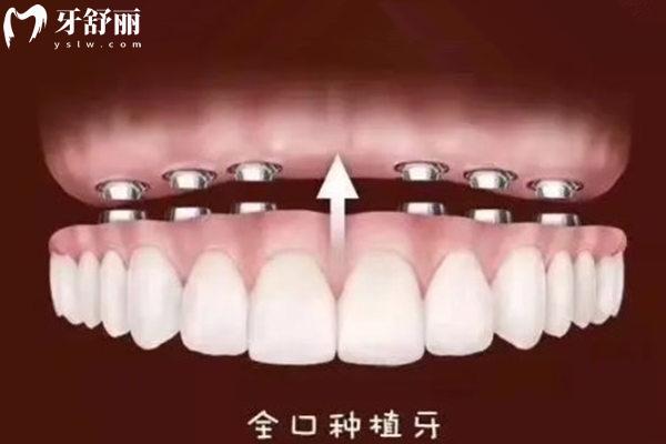 順義**種牙