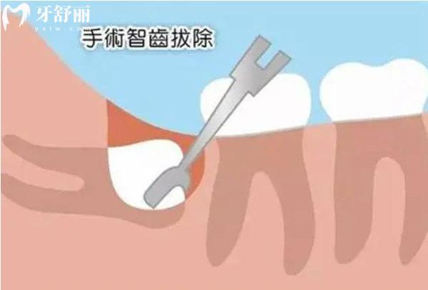 順義**拔牙