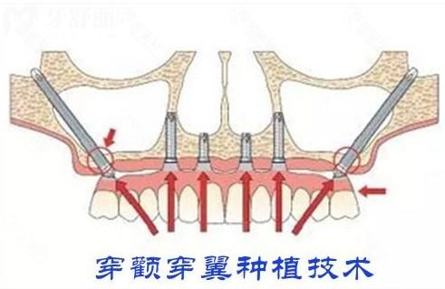 穿顴穿翼種植技術(shù)
