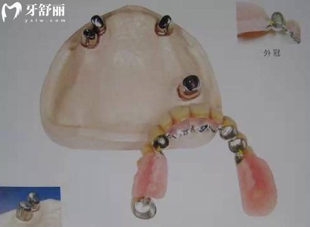 套筒冠附著體