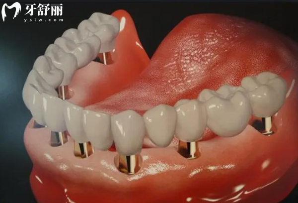 北京全口種植牙價格表