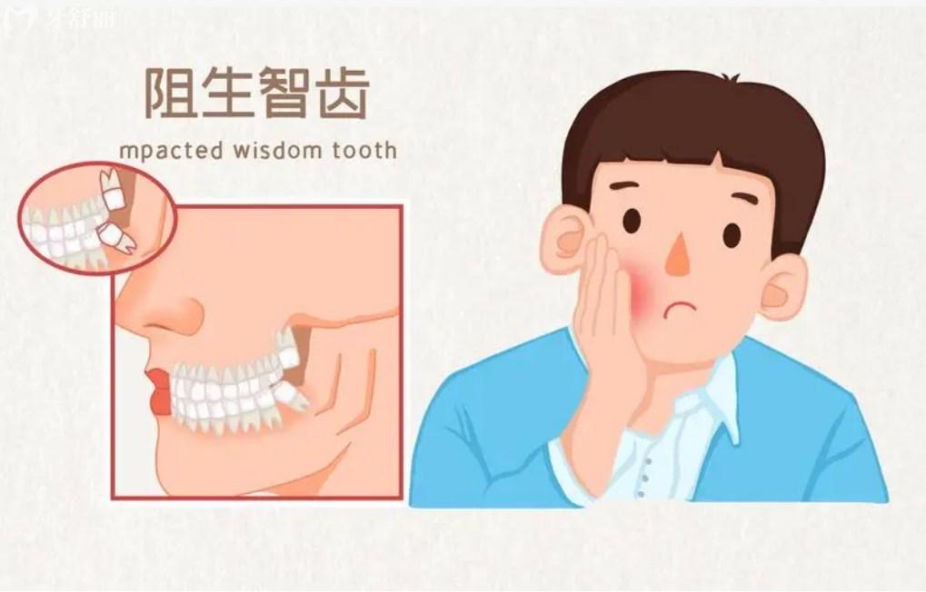 阻生智齒示意圖