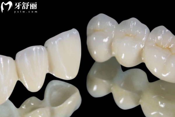鑲牙牙冠