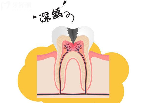 北京兒童根管治療