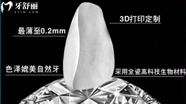 超薄瓷貼面的優(yōu)勢(shì)