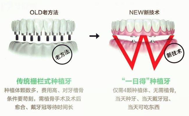 北京延慶區(qū)全口種植牙多少錢(qián)