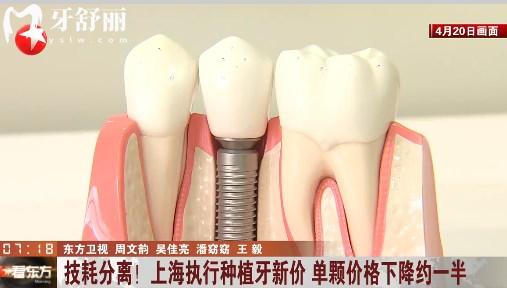 上海種植牙集采降價(jià)通知